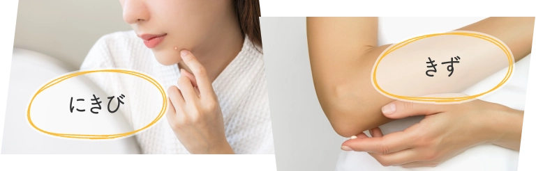 にきび きず イメージ